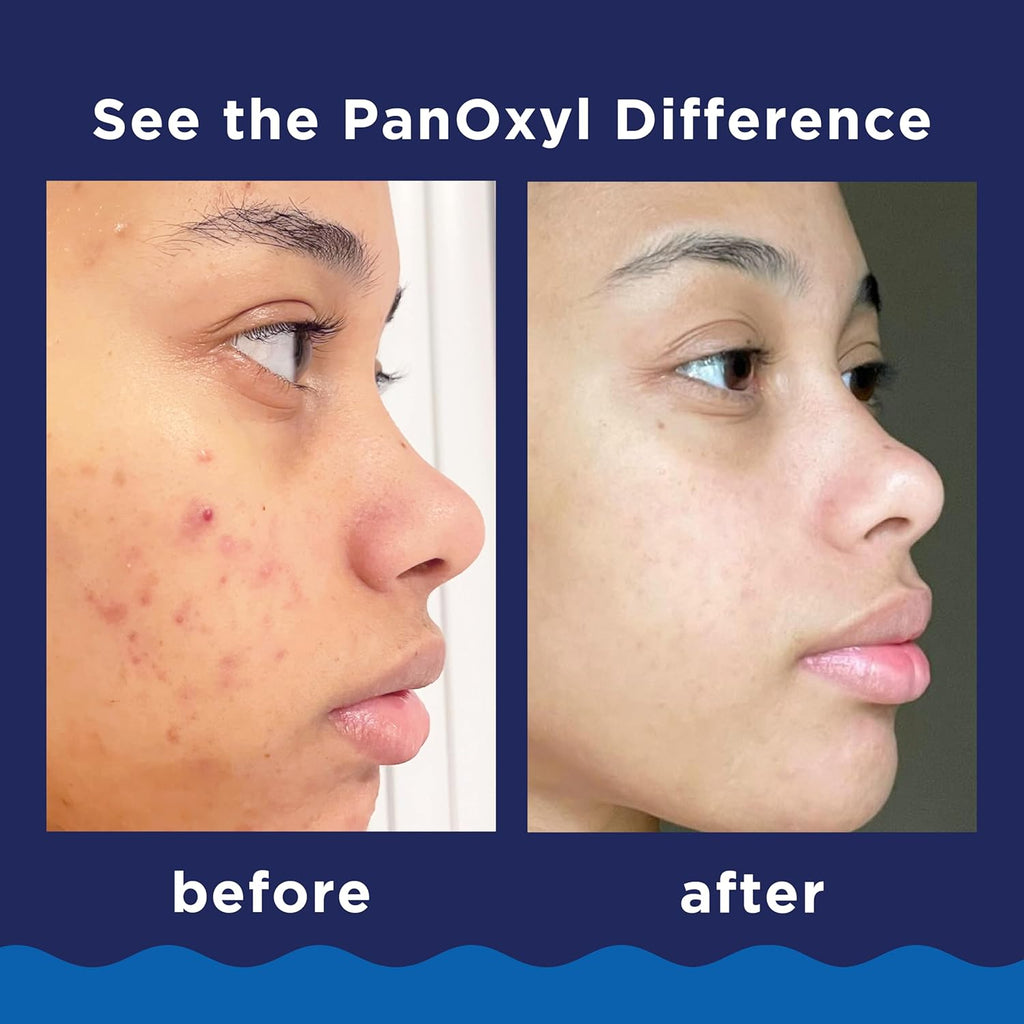PanOxyl 10% Benzoyl Peroxide Acne Foaming Wash, Maximum Strength, Daily