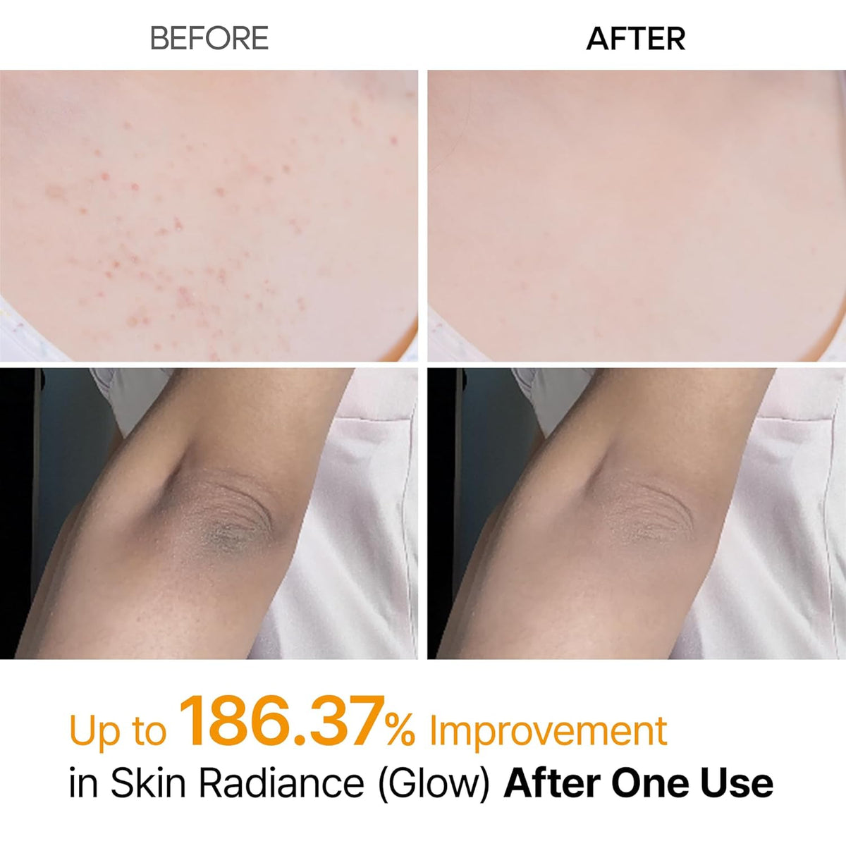 Dr.Melaxin Body Keratin Care Kojic Acid Turmeric Spray with AHA & PHA, Gentle